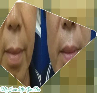 Before and after gua sha stone