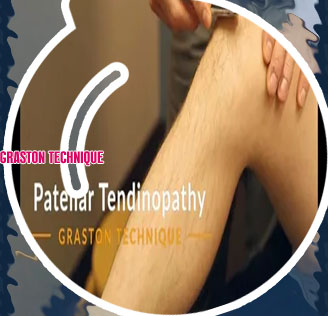 Graston technique gua sha